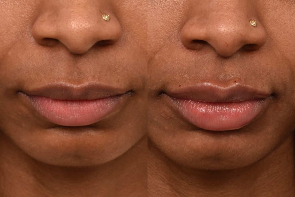 patient before and after lip filler