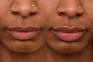 patient before and after lip filler