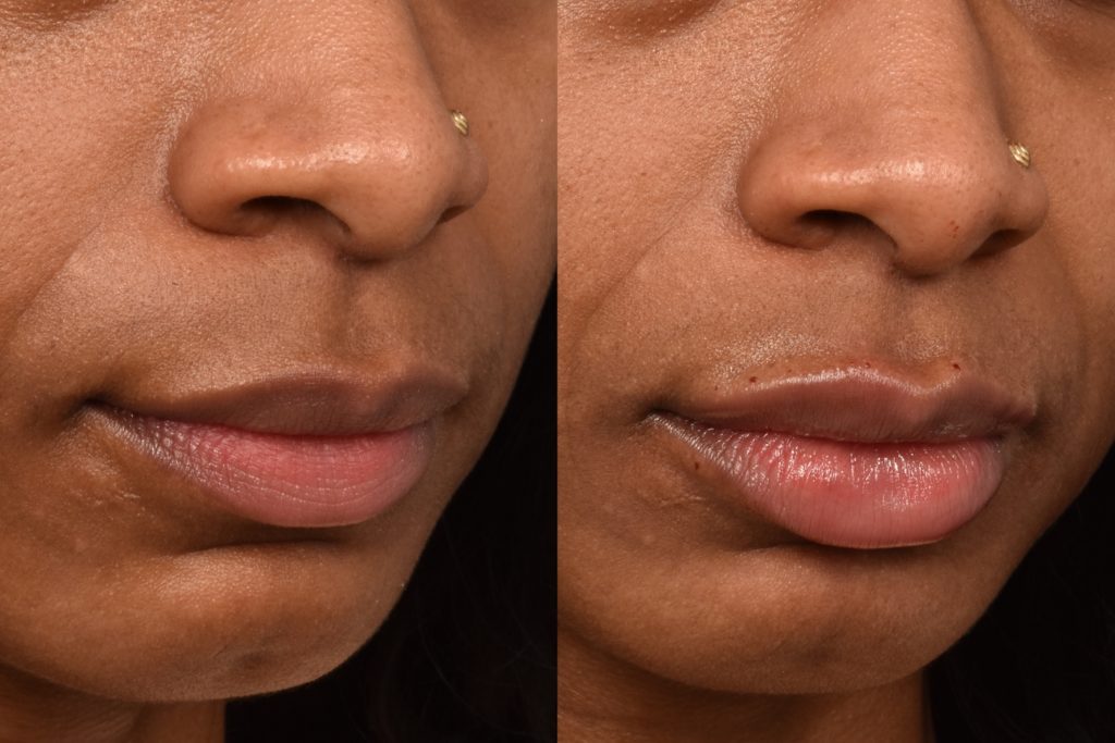 patient before and after lip filler