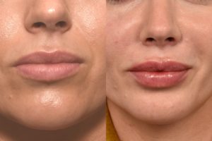 patient before and after lip filler