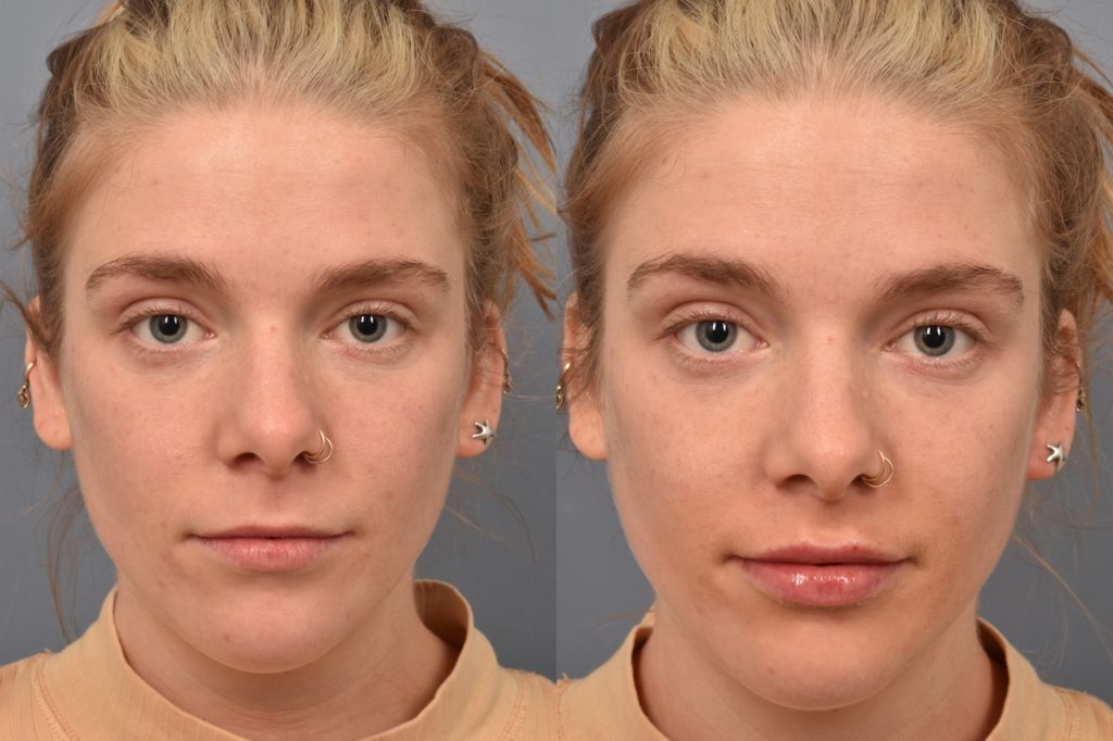 patient before and after lip filler