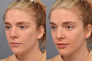 patient before and after lip filler