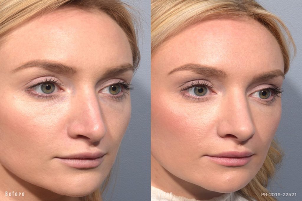 female patient before and after rhinoplasty