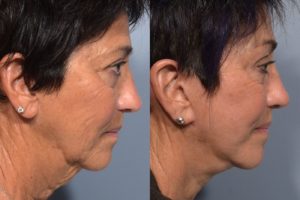 patient before and after facelift