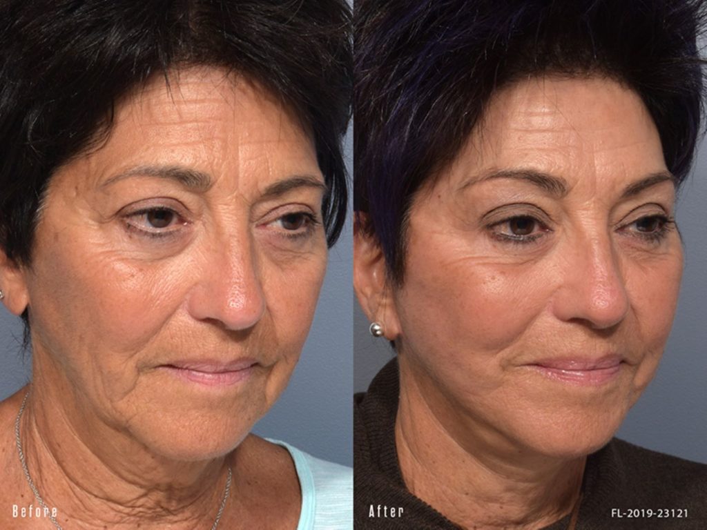 patient before and after facelift