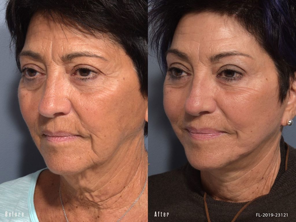 patient before and after facelift