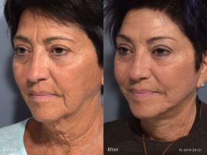 patient before and after facelift
