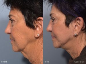 patient before and after facelift