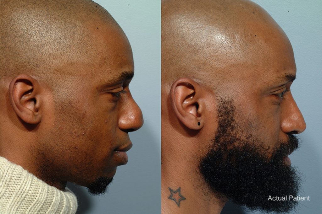 patient before and after revision rhinoplasty