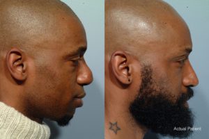 patient before and after revision rhinoplasty