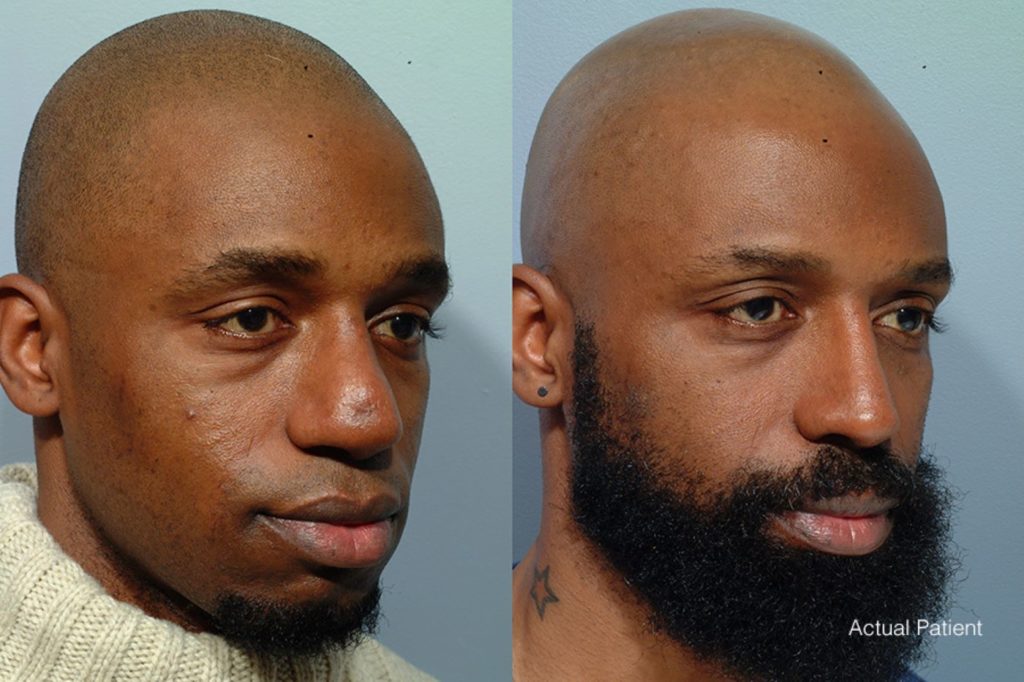 patient before and after revision rhinoplasty
