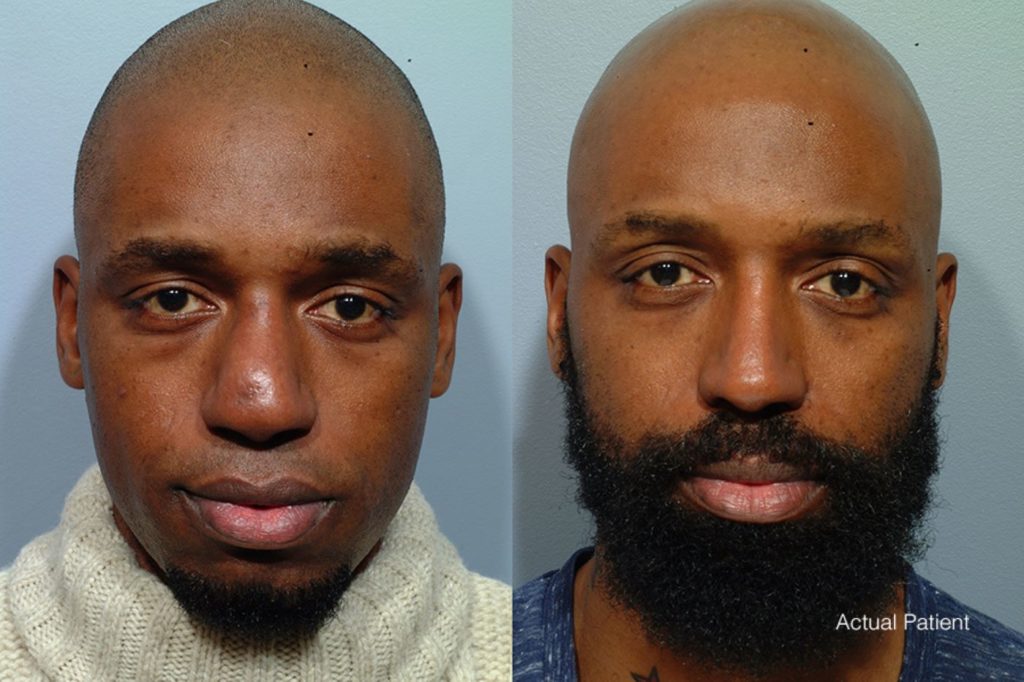 patient before and after revision rhinoplasty