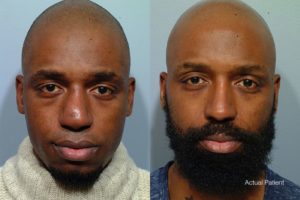 patient before and after revision rhinoplasty