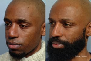 patient before and after revision rhinoplasty