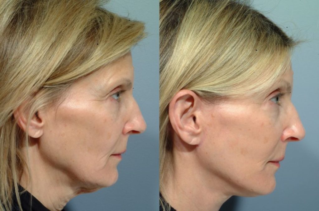 patient before and after facelift