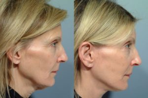 patient before and after facelift