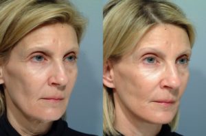 patient before and after facelift