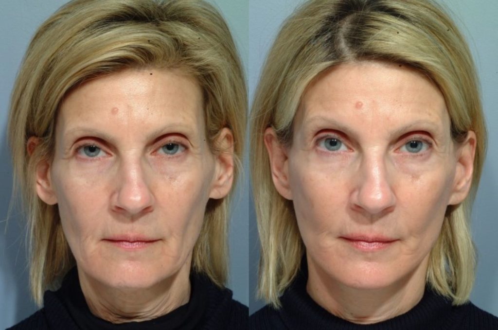 patient before and after facelift