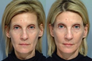 patient before and after facelift