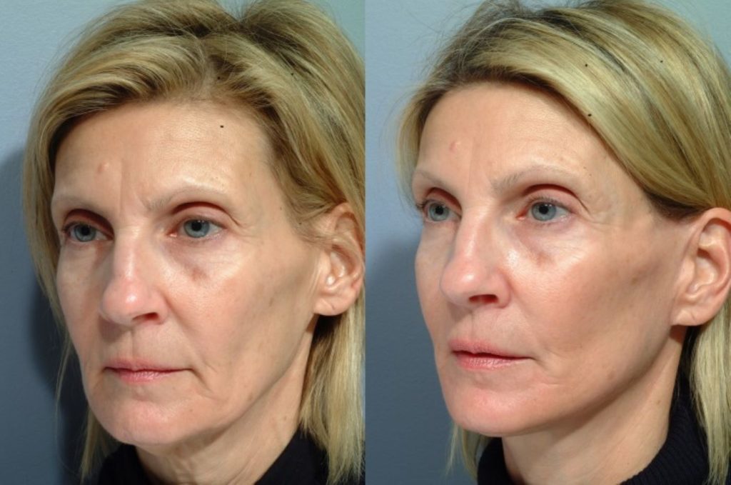 patient before and after facelift