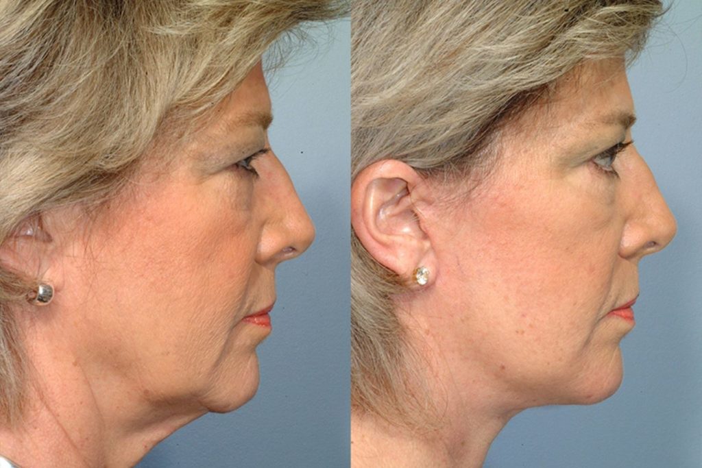 patient before and after facelift