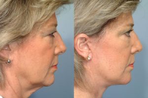 patient before and after facelift