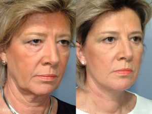 patient before and after facelift