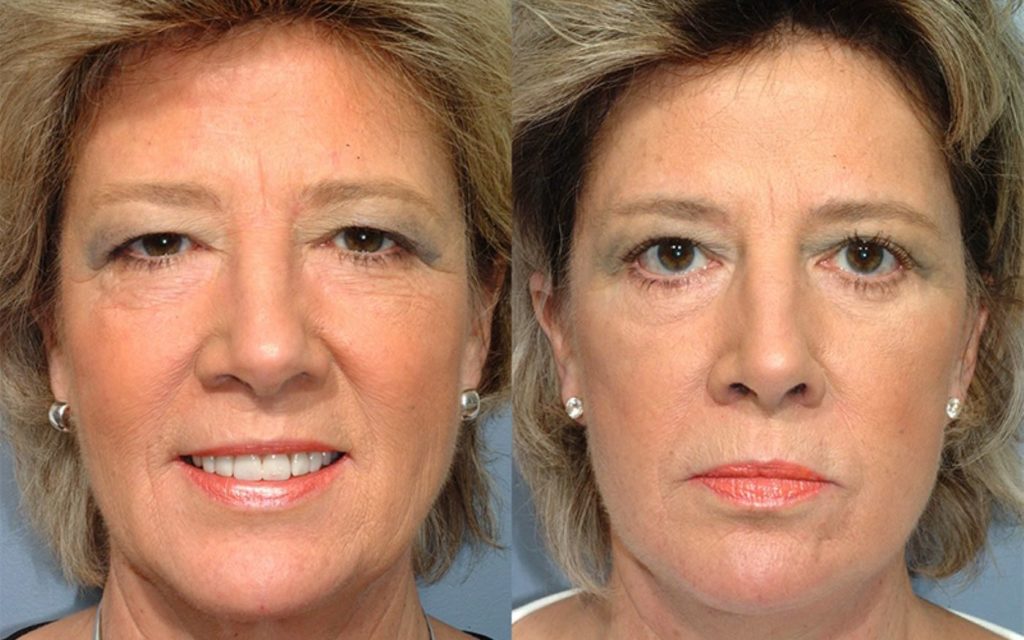 patient before and after facelift