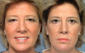 patient before and after facelift