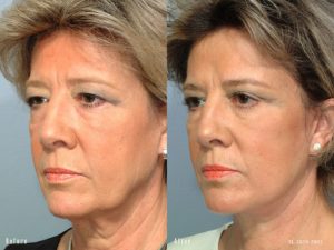 patient before and after facelift