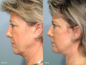 patient before and after facelift