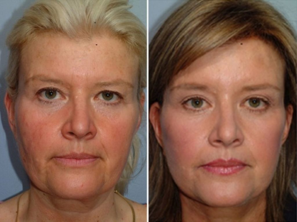 patient before and after facelift