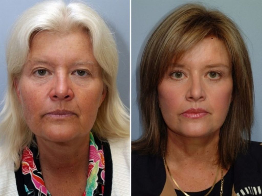 patient before and after facelift