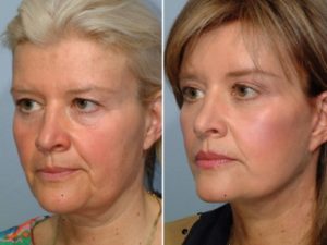 patient before and after facelift