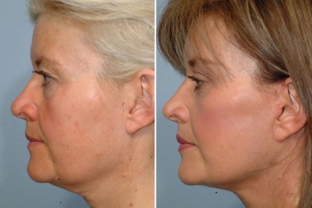 patient before and after facelift