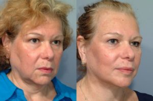 patient before and after facelift