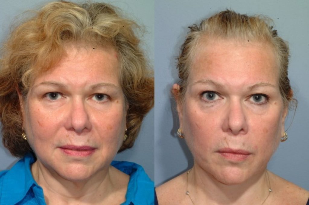 patient before and after facelift