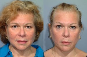 patient before and after facelift
