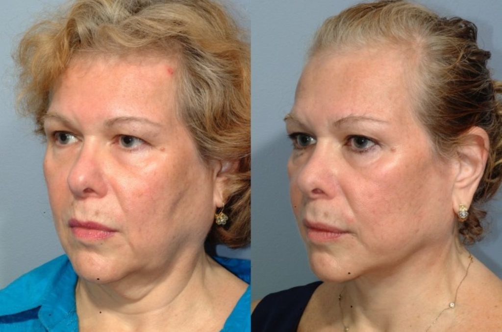 patient before and after facelift