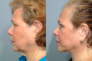 patient before and after facelift