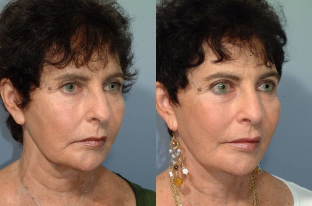 patient before and after facelift
