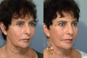 patient before and after facelift