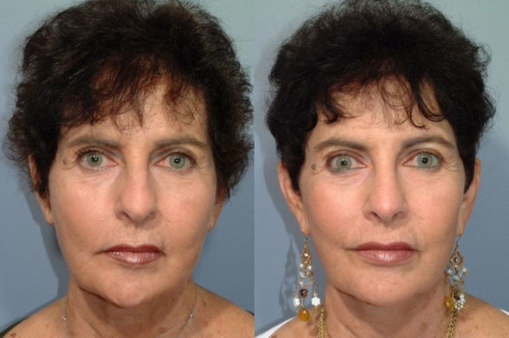patient before and after facelift