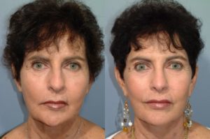 patient before and after facelift