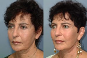 patient before and after facelift
