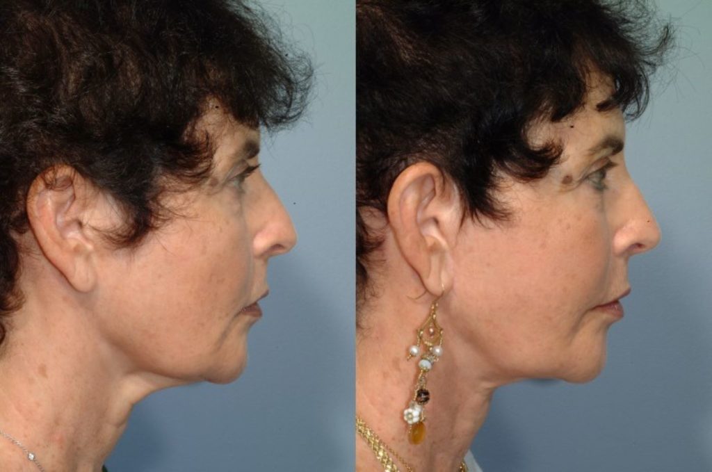 patient before and after facelift
