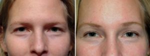patient before and after brow lift