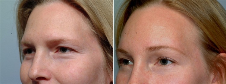 patient before and after brow lift