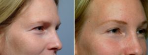 patient before and after brow lift