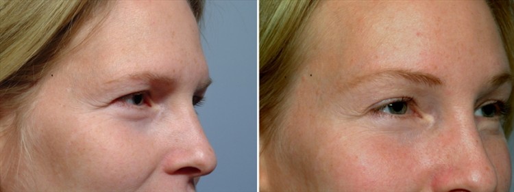 patient before and after brow lift